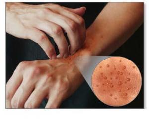 cómo tratar la dermatitis atópica